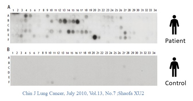 Peptide Microarray - COVID-19. Automation Liquid Handling, Chin J Lung Cancer